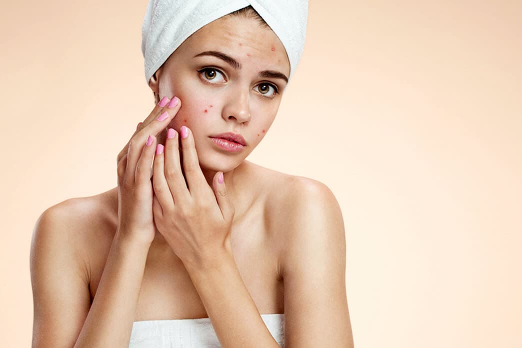 Acne Treatment